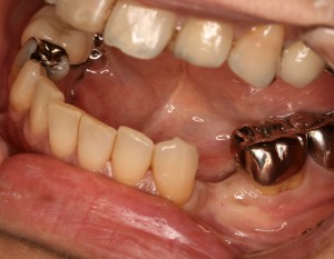 河合３　抜歯後・埋入直前